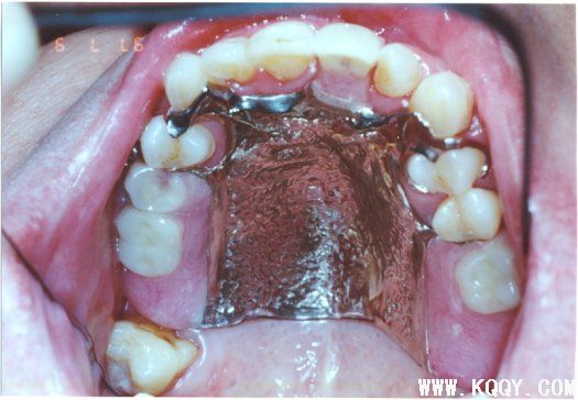 局部可摘义齿修复病例