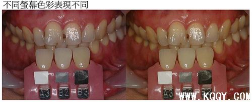 牙技所为什么要做色彩管理?