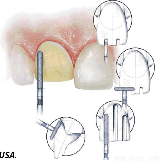 修复体牙齿预备小知识