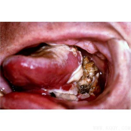 口腔癌图片