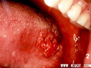 口腔鳞状细胞癌
