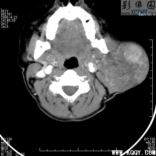 腮腺混合瘤（Parotid Mixed tumor）CT病例图片影像