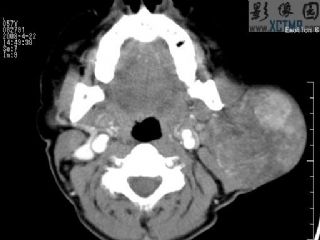 腮腺混合瘤（Parotid Mixed tumor）CT病例图片影像