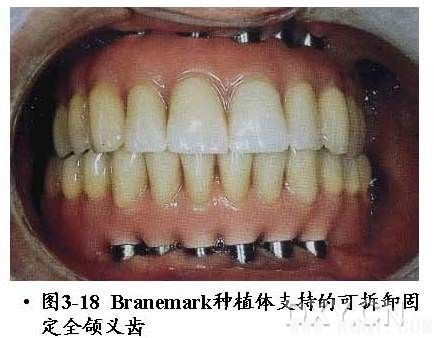 Branemark种植体系统详解