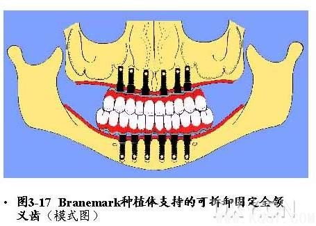 Branemark种植体系统详解