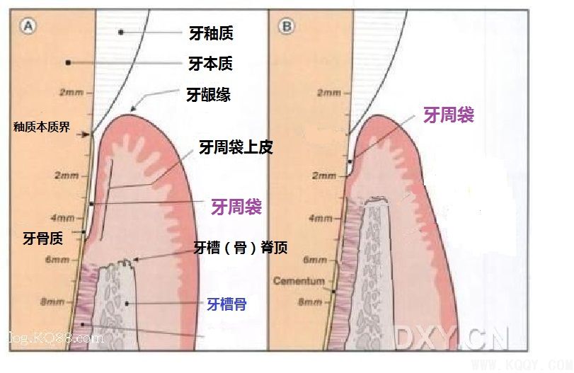 什么是龈下刮治