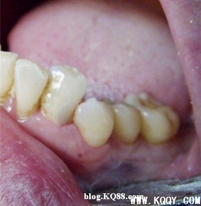 改良开髓位置保护牙体组织