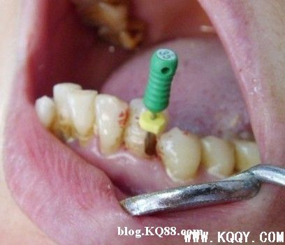 改良开髓位置保护牙体组织