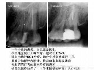 根管内断针治疗病例