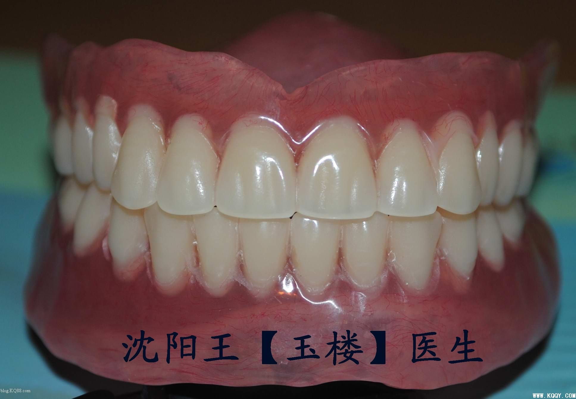 旧义齿配合硅胶印模材简化总义齿制作病例