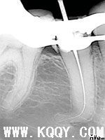 极度弯曲牙根管治疗