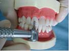 瓷贴面修复牙体预备中的操作要点
