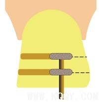 瓷贴面修复牙体预备中的操作要点