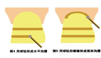 瓷贴面修复牙体预备中的操作要点
