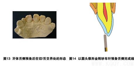 瓷贴面修复牙体预备中的操作要点