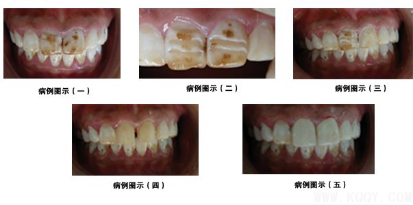 瓷贴面修复牙体预备中的操作要点