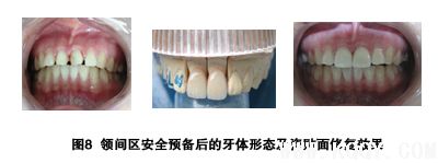 瓷贴面修复牙体预备中的操作要点
