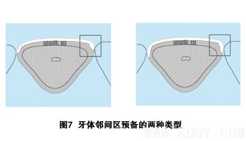 瓷贴面修复牙体预备中的操作要点