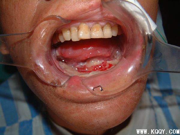 牙龈癌临床图片