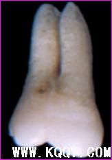 上颌第二磨牙解剖结构详解