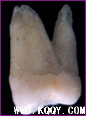 上颌第二磨牙解剖结构详解