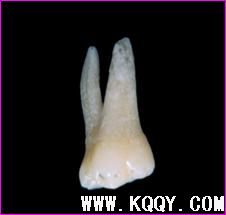 上颌第一磨牙解剖形态详解