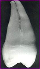 上颌第一前磨牙解剖形态详解
