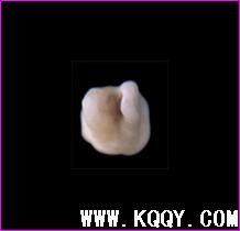下颌第一磨牙解剖形态详解