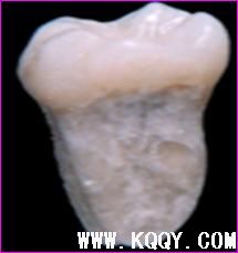下颌第一磨牙解剖形态详解