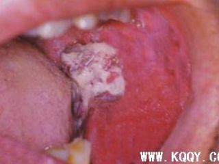 牙龈癌图片