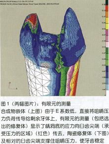 非金属修复---全瓷是新一代修复技术