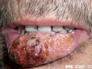 唇癌临床图片