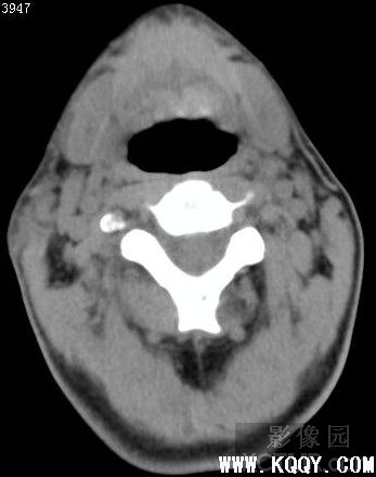 甲状舌骨囊肿CT病例(影像图)