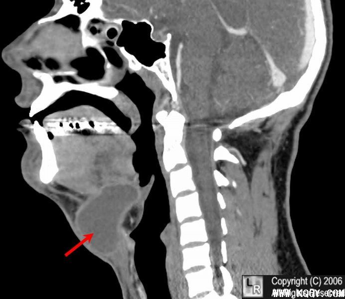 甲状舌管囊肿CT图
