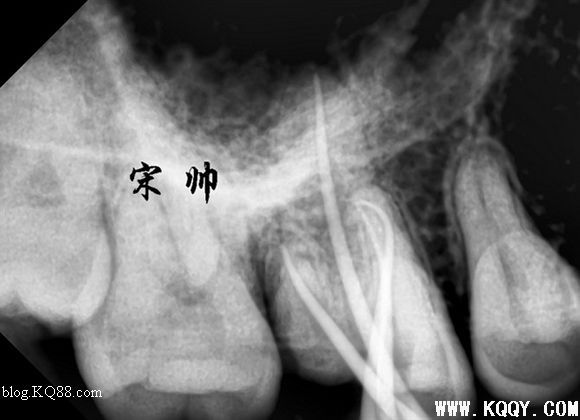 上颌磨牙寻找MB2，感受MB2根管治疗