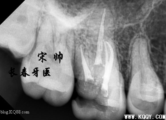 上颌磨牙寻找MB2，感受MB2根管治疗