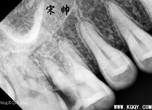 上颌磨牙寻找MB2，感受MB2根管治疗