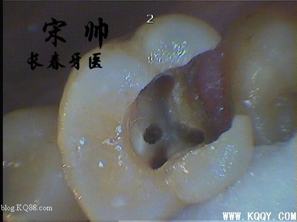 上颌磨牙寻找MB2，感受MB2根管治疗