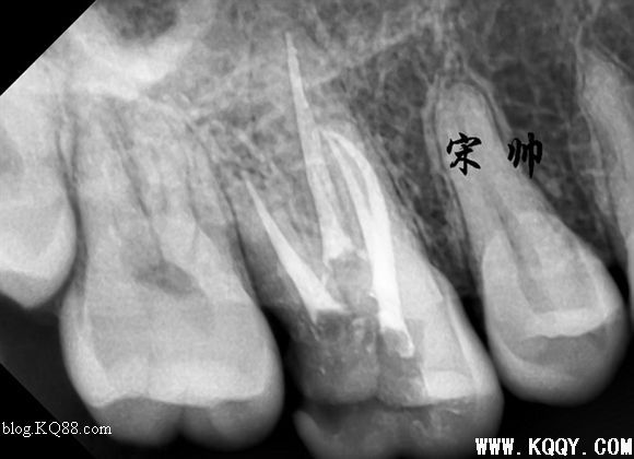 上颌磨牙寻找MB2，感受MB2根管治疗