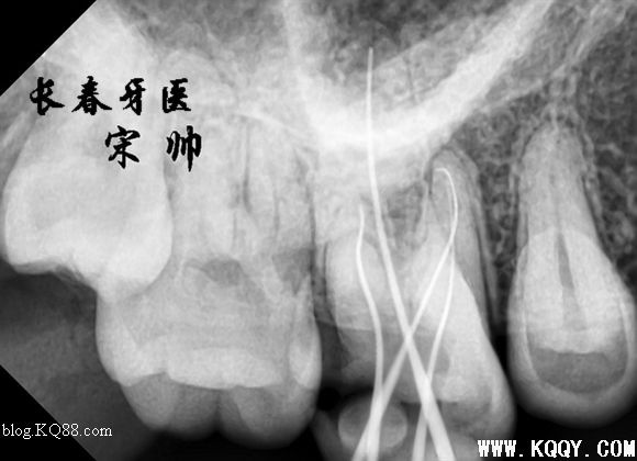 上颌磨牙寻找MB2，感受MB2根管治疗