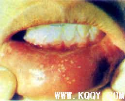 口腔黏膜疾病简述——疱疹性口炎