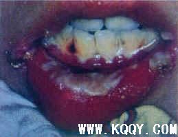 口腔黏膜疾病简述——坏死性龈口炎