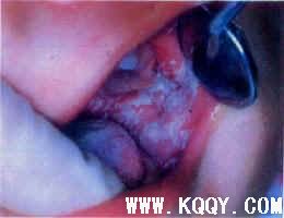 口腔黏膜疾病概述——口腔念珠菌病