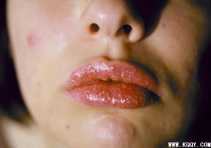 口腔粘膜疾病简述——变态反应性口炎