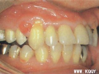 纤维性牙龈瘤临床图片