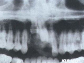 牙槽突骨折X线图片