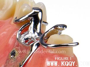 全冠与局部可摘义齿修复方法