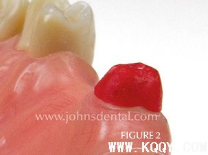 全冠与局部可摘义齿修复方法