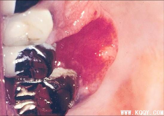 早期舌癌临床图片与组织病理图片