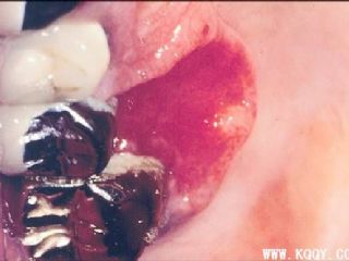 早期舌癌临床图片与组织病理图片